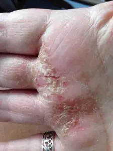 Hand Eczema Before Aloe Vera