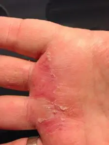 Hand Eczema after one day of using Aloe Vera