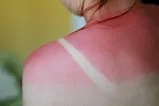 sunburned shoulders